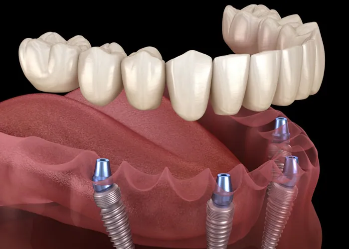 Dental Implants